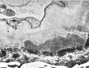 F,74y. | membranous glomerulopathy F,74y. | membranous glomerulopathy